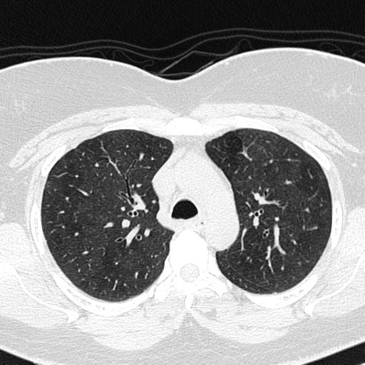 File:Air trapping in small airway disease (Radiopaedia 61685-69694 Axial lung window 51).jpg