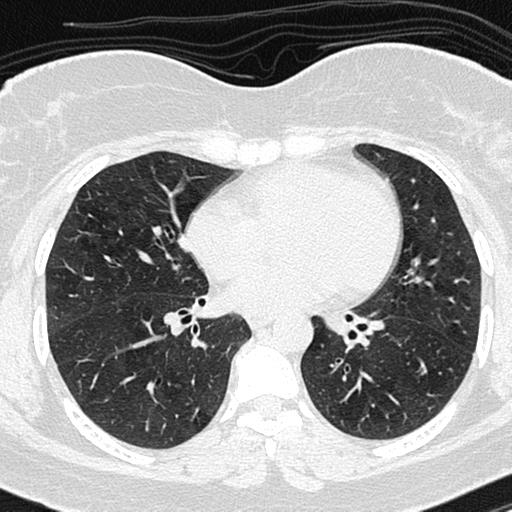 Air trapping in small airway disease (Radiopaedia 61685-69694 Axial lung window 95).jpg