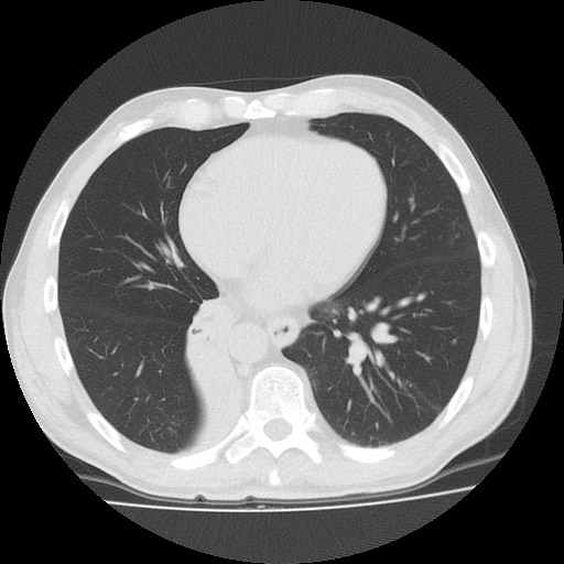 Allergic bronchopulmonary aspergillosis (ABPA) (Radiopaedia 60594-68313 Axial lung window 40).jpg