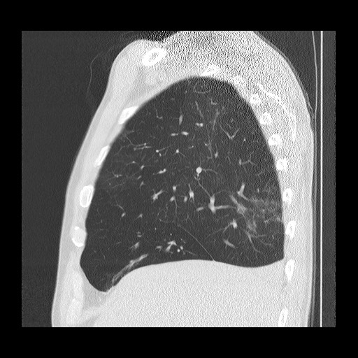Allergic bronchopulmonary aspergillosis (ABPA) (Radiopaedia 60594-68313 Sagittal lung window 45).jpg