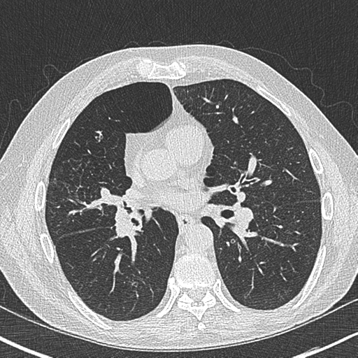 Allergic bronchopulmonary aspergillosis (Radiopaedia 44760-48571 Axial lung window 35).png