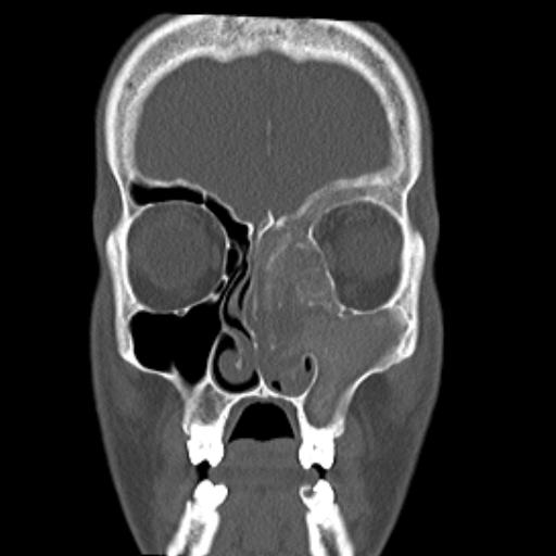 File:Allergic fungal sinusitis (Radiopaedia 29086-29455 Coronal bone window 14).jpg