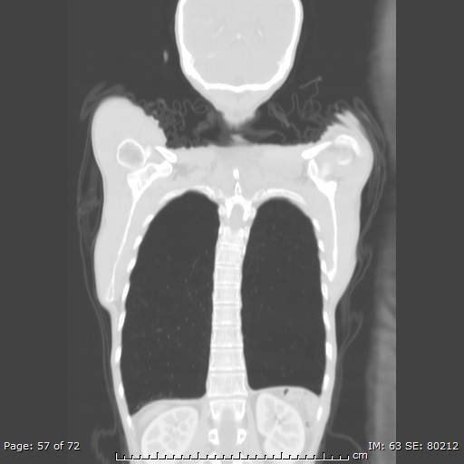 Alpha-1-antitrypsin deficiency (Radiopaedia 50561-55987 Coronal lung window 55).jpg