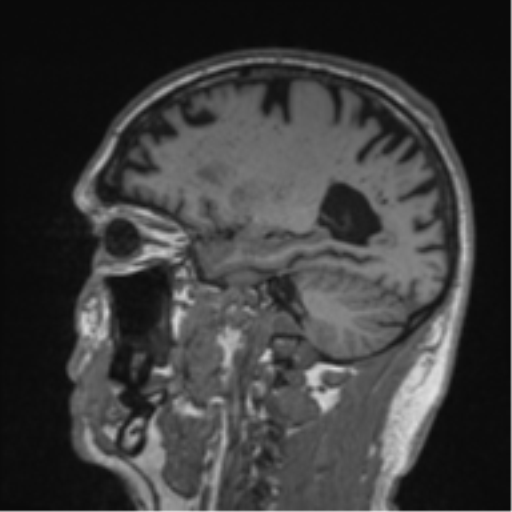 File:Alzheimer's disease- with Gerstmann syndrome and dressing apraxia (Radiopaedia 54882-61150 Sagittal T1 49).png