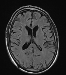 File:Alzheimer's disease- with apraxia (Radiopaedia 54763-61011 Axial FLAIR 16).png
