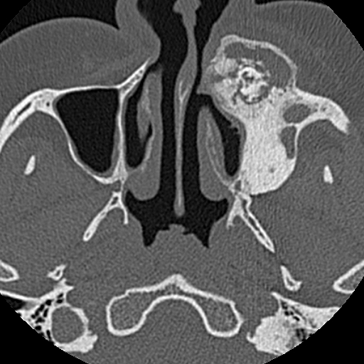 File:Ameloblastic fibro-odontoma (Radiopaedia 18843-18780 C 23).jpg