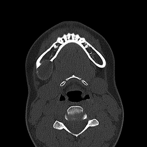 File:Ameloblastoma (Radiopaedia 26645-26793 E 16).jpg
