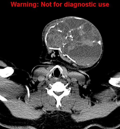 File:Ameloblastoma (Radiopaedia 33126-34164 B 27).jpg