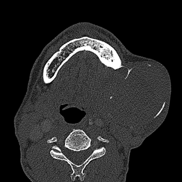 Ameloblastoma (Radiopaedia 51921-57766 Axial bone window 40).jpg