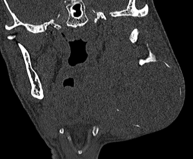Ameloblastoma (Radiopaedia 51921-57766 Coronal bone window 160).jpg