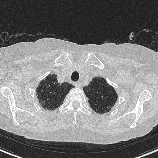 Amiodarone-induced pulmonary fibrosis (Radiopaedia 82355-96460 Axial lung window 9).jpg
