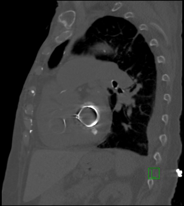 Amiodarone deposition in the liver (Radiopaedia 77587-89780 Sagittal bone window 39).jpg