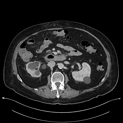 Ampullary adenocarcinoma (Radiopaedia 59373-66737 A 73).jpg