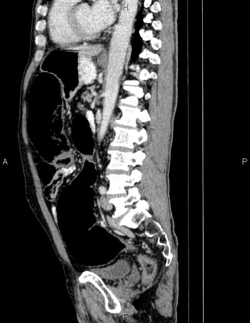 Ampullary adenocarcinoma (Radiopaedia 86093-102032 D 57).jpg