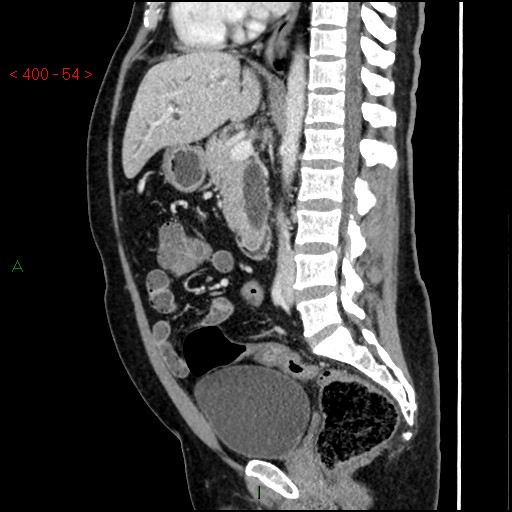 Ampullary carcinoma (Radiopaedia 56396-63056 D 53).jpg