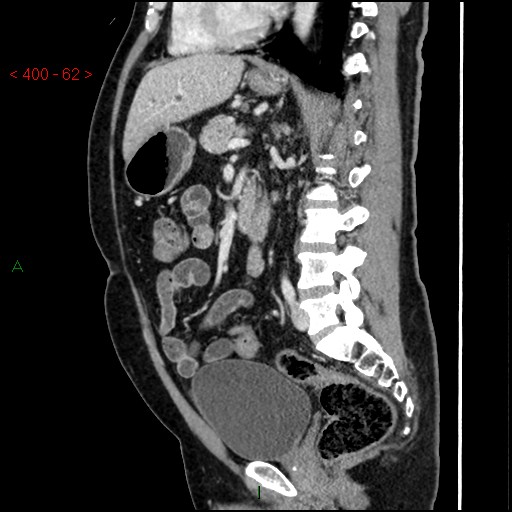 Ampullary carcinoma (Radiopaedia 56396-63056 D 61).jpg