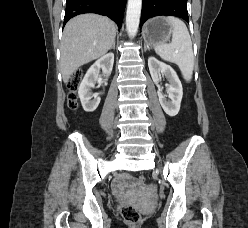 Ampullary tumor (Radiopaedia 60333-67998 B 52).jpg