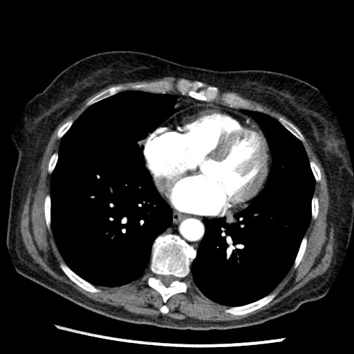 Amyloidosis - bronchial and diffuse nodular pulmonary involvement (Radiopaedia 60156-67745 A 35).jpg
