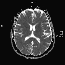File:Amyotrophic lateral sclerosis (Radiopaedia 70821-81017 Axial ADC 13).jpg