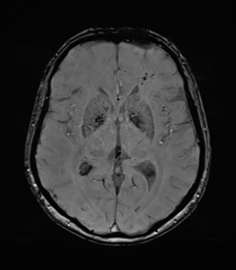 Anaplastic astrocytoma (Radiopaedia 86943-103160 Axial SWI 46).png