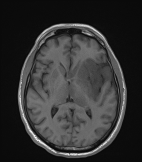 Anaplastic astrocytoma IDH wild-type (Radiopaedia 49984-55273 Axial T1 30).png
