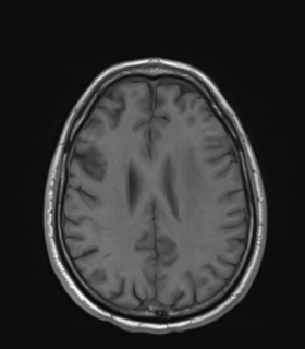 Anaplastic astrocytoma IDH wild-type (Radiopaedia 49984-55273 Axial T1 39).png