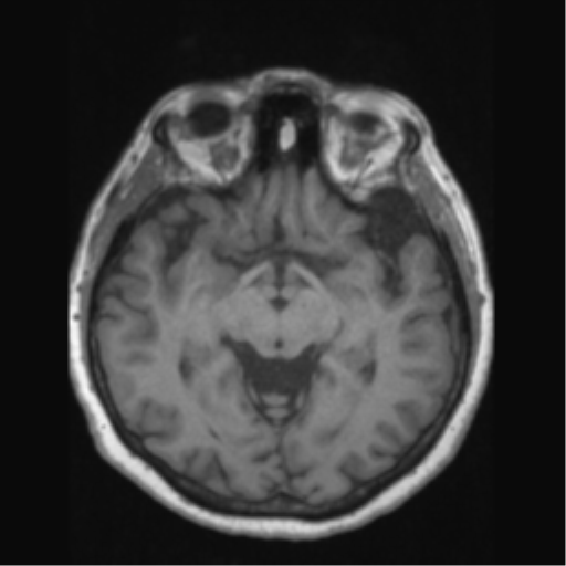 File:Anaplastic astrocytoma IDH wild-type (pseudoprogression) (Radiopaedia 42209-45276 Axial T1 69).png