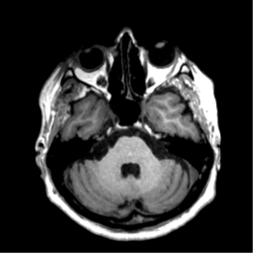 File:Anaplastic astrocytoma IDH wild-type (pseudoprogression) (Radiopaedia 42209-45277 Axial T1 36).png