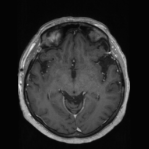 File:Anaplastic astrocytoma IDH wild-type (pseudoprogression) (Radiopaedia 42209-45278 Axial T1 C+ 73).png