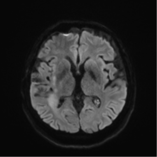 File:Anaplastic astrocytoma IDH wild-type (pseudoprogression) (Radiopaedia 42209-45279 Axial DWI 41).png