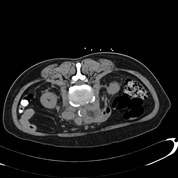 File:Anaplastic lymphoma - with CT biopsy (Radiopaedia 21643-21602 Axial non-contrast 39).jpg