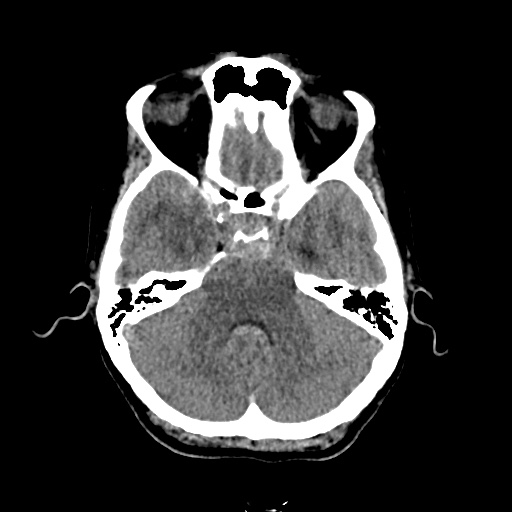 Aneursym related subarachnoid hemorrhage with hydrocephalus (Radiopaedia 45105-49083 Axial non-contrast 11).jpg