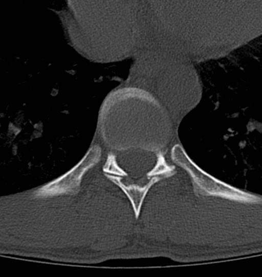 Aneurysmal bone cyst T11 (Radiopaedia 29294-29721 Axial bone window 28).jpg