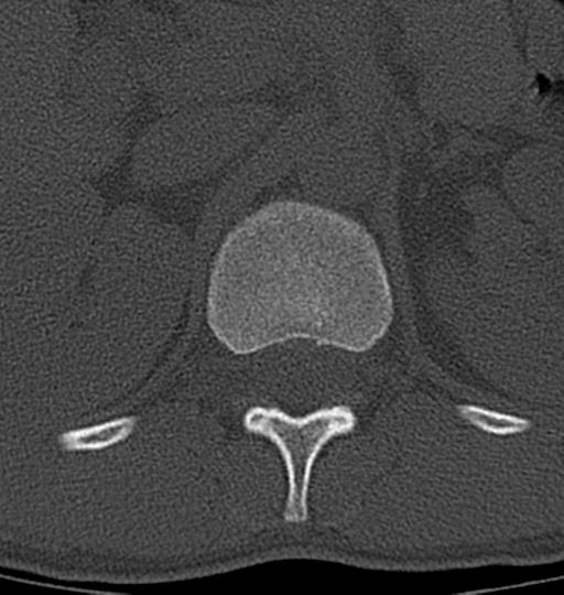 Aneurysmal bone cyst T11 (Radiopaedia 29294-29721 Axial bone window 57).jpg