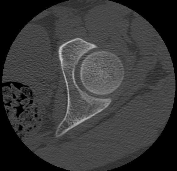 File:Aneurysmal bone cyst of ischium (Radiopaedia 25957-26094 B 1).png