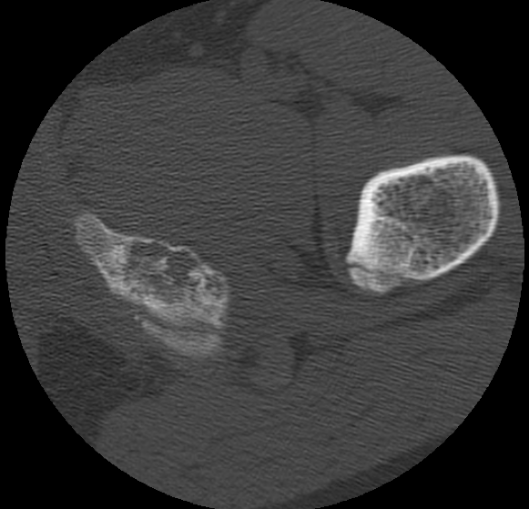Aneurysmal bone cyst of ischium (Radiopaedia 25957-26094 B 51).png