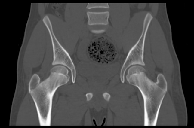 File:Aneurysmal bone cyst of ischium (Radiopaedia 25957-26094 Coronal bone window 20).png