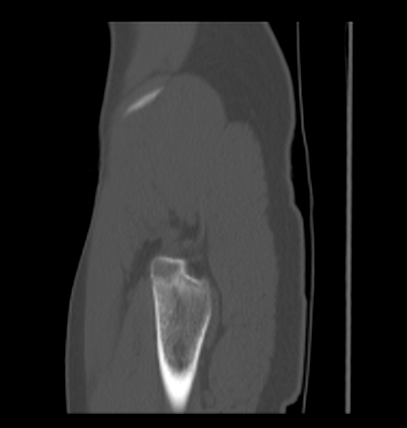 Aneurysmal bone cyst of ischium (Radiopaedia 25957-26094 Sagittal bone window 67).png