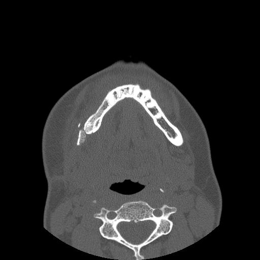 Aneurysmal bone cyst of the mandible (Radiopaedia 43280-46823 Axial bone window 36).jpg