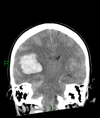 Aneurysmal subarachnoid hemorrhage with intra-axial extension (Radiopaedia 84371-99699 Coronal non-contrast 32).jpg