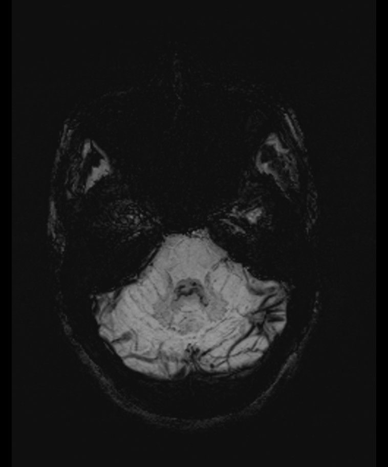 Angiomatous meningioma (Radiopaedia 79459-92579 E 14).jpg