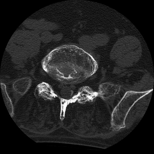 Ankylosing spondylitis complicated by fracture-dislocation (Radiopaedia 33583-34674 Axial non-contrast 137).jpg