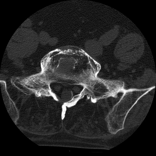 File:Ankylosing spondylitis complicated by fracture-dislocation (Radiopaedia 33583-34674 Axial non-contrast 144).jpg