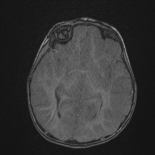 Anoxic brain injury (Radiopaedia 79165-92139 Axial MRA 114).jpg