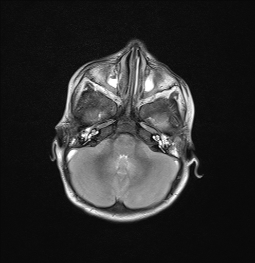 File:Anoxic brain injury (Radiopaedia 79165-92139 Axial T2 7).jpg