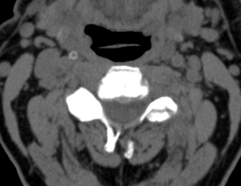 Anterior cervical postdiscectomy arthrodesis (Radiopaedia 32678-33646 Axial non-contrast 31).jpg