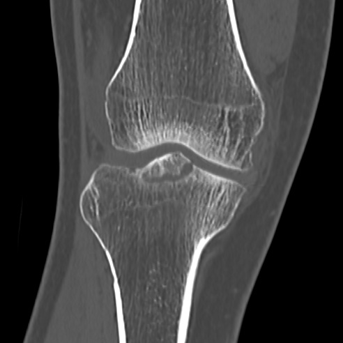 File:Anterior cruciate ligament avulsion fracture (Radiopaedia 58939-66194 Coronal bone window 10).jpg