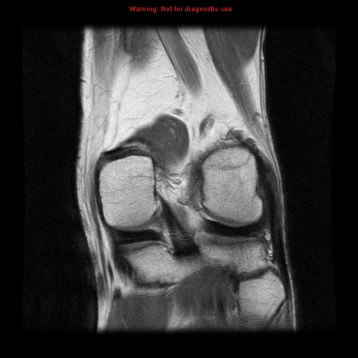 File:Anterior cruciate ligament injury - partial thickness tear (Radiopaedia 12176-12515 Coronal PD 14).jpg