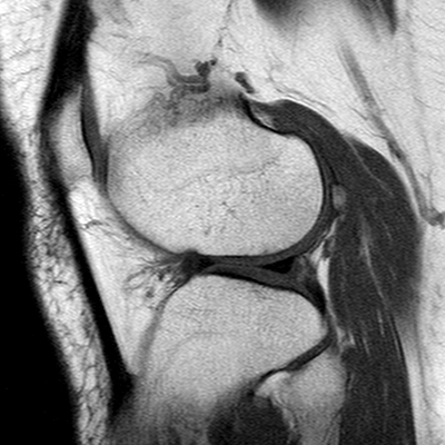 Anterior cruciate ligament mucoid degeneration (Radiopaedia 60853-68633 Sagittal T1 50).jpg
