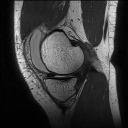 Anterior cruciate ligament rupture with Segond fracture (Radiopaedia 69043-78806 Sagittal PD 52).jpg